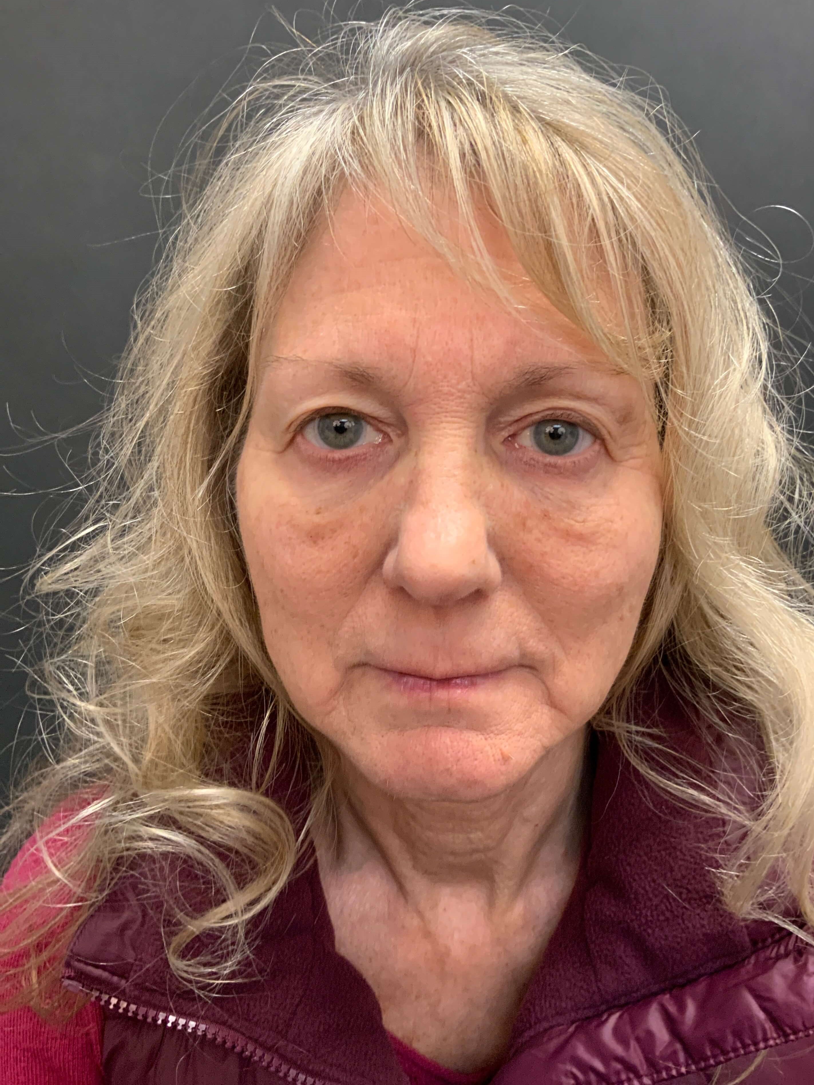 LIQUID & NON SURGICAL FACELIFT Before
