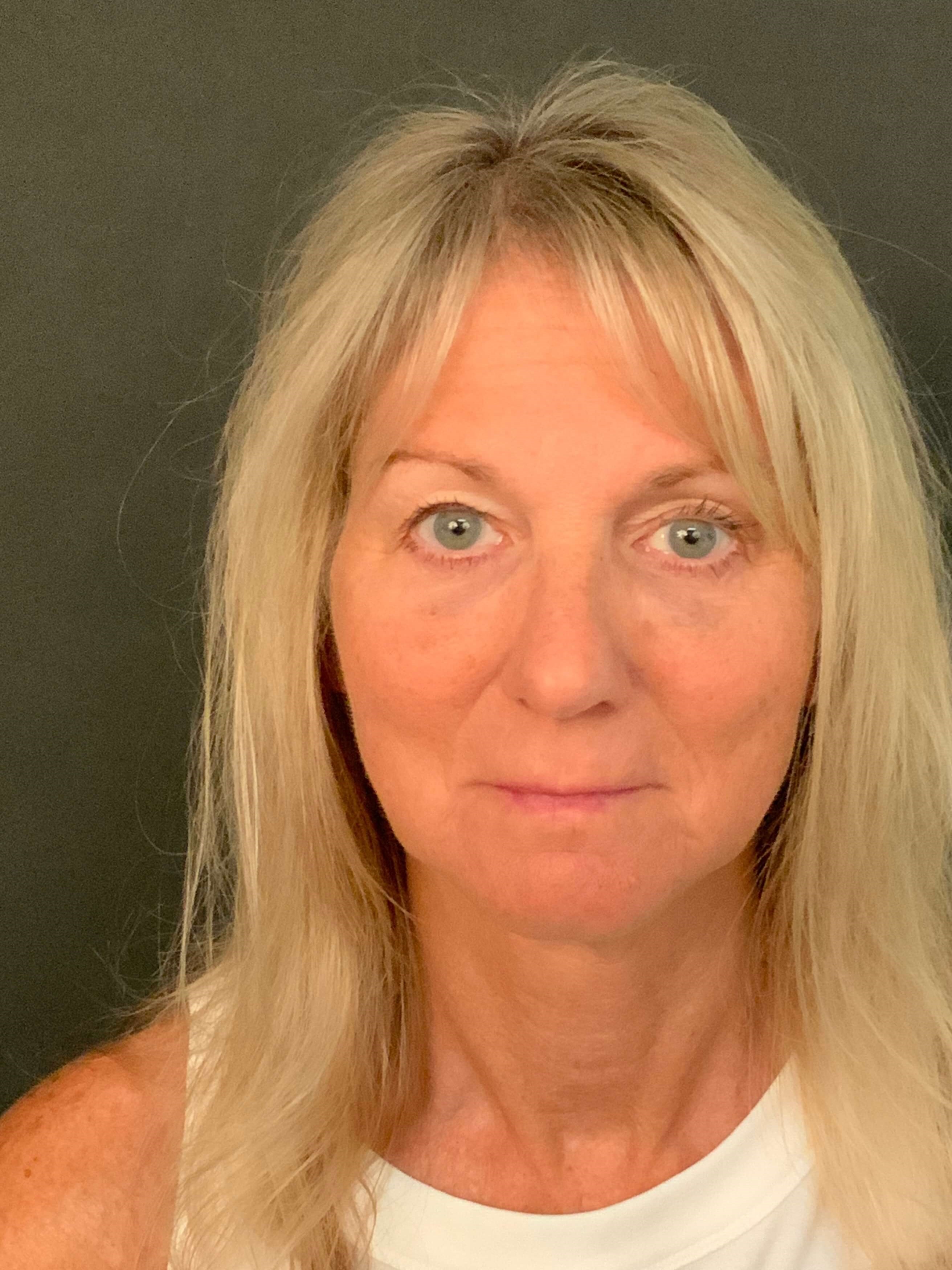 LIQUID & NON SURGICAL FACELIFT After