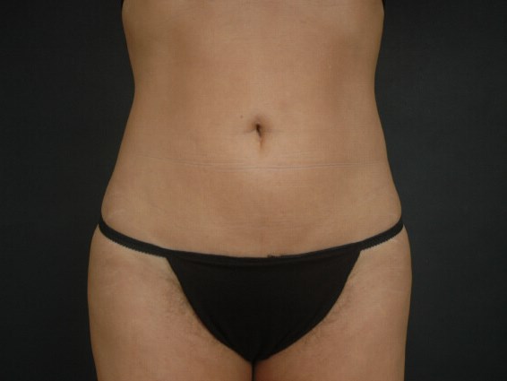 Liposuction - Abdomen After