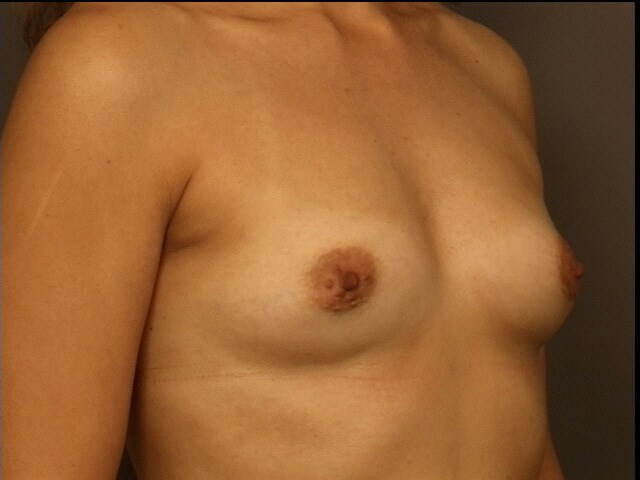 Breast Augmentation Before