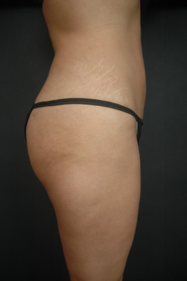 Liposuction - Abdomen After
