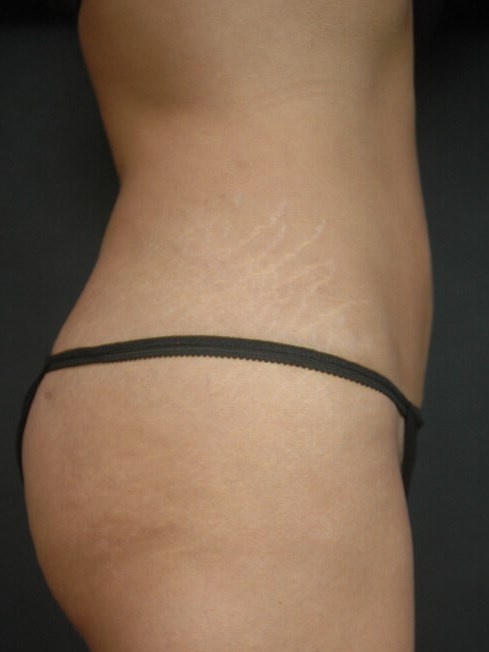 Liposuction - Abdomen After