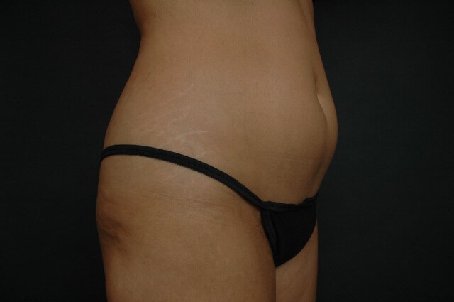 Liposuction - Abdomen Before