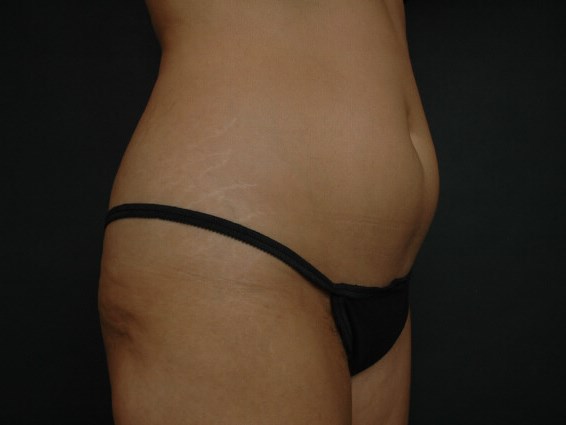 Liposuction - Abdomen Before