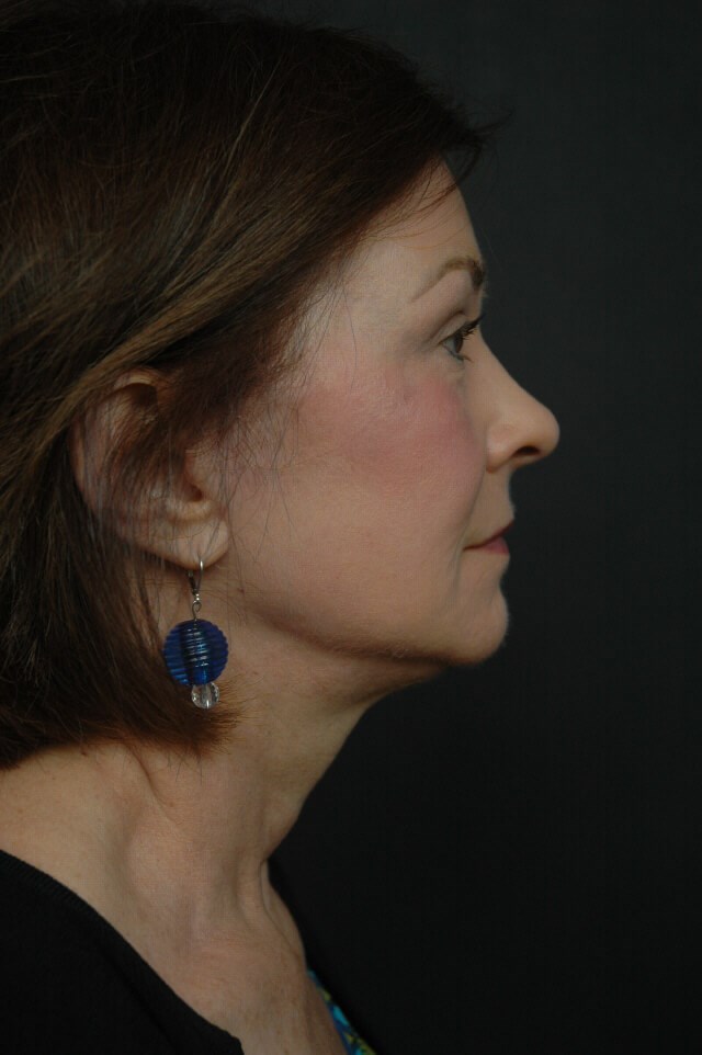 Facelift After
