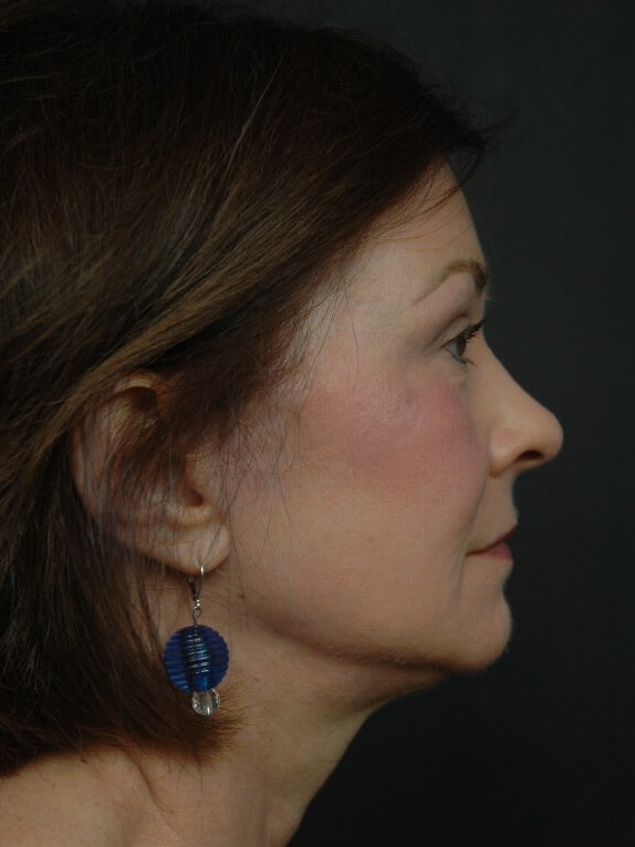 Facelift After