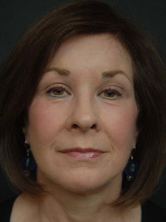 Facelift After