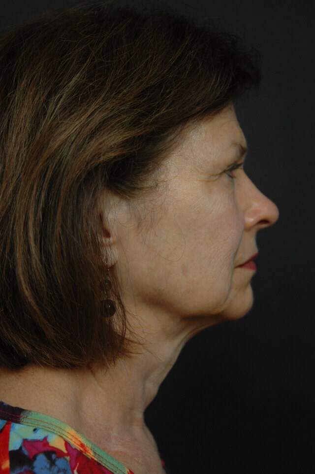 Facelift Before