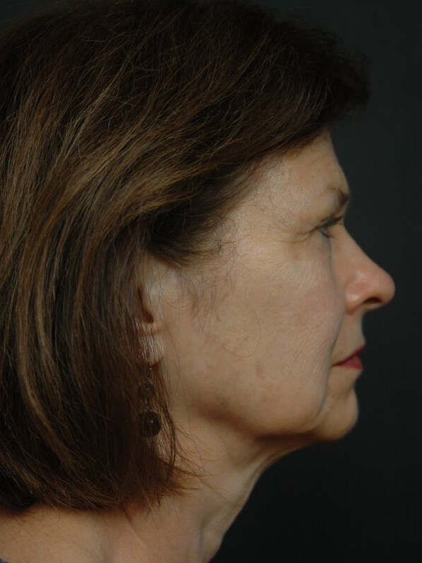 Facelift Before