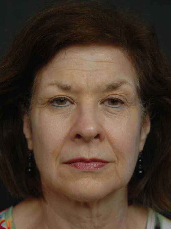 Facelift Before