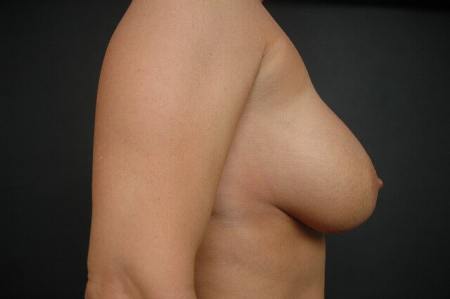 Breast Augmentation After