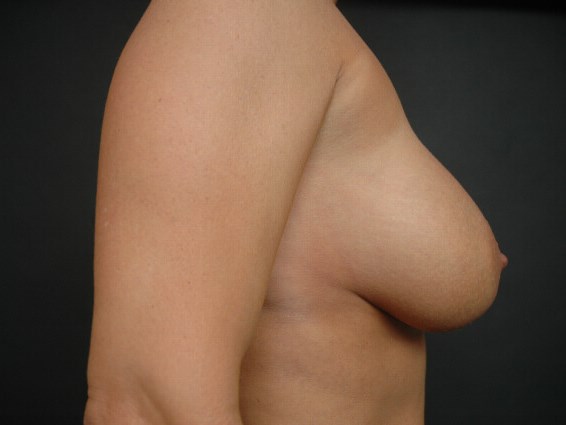 Breast Augmentation After