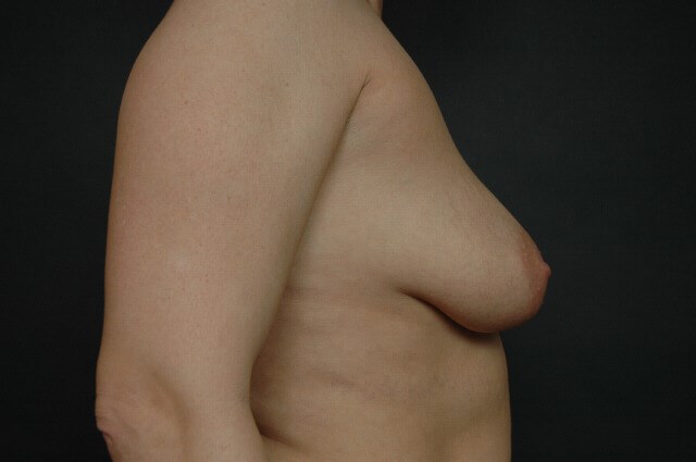 Breast Augmentation Before