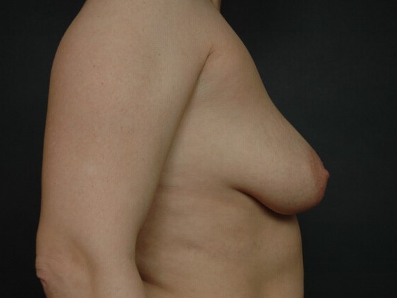 Breast Augmentation Before