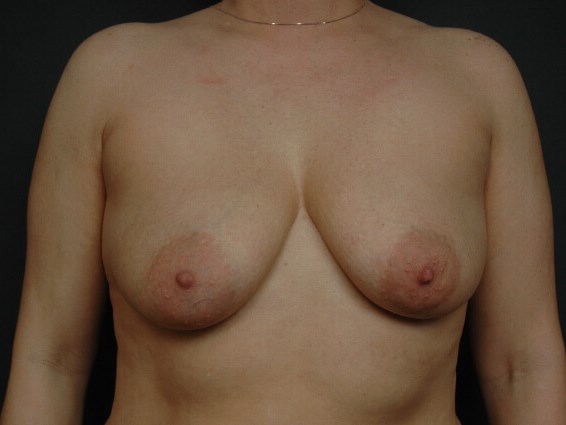 Breast Augmentation Before