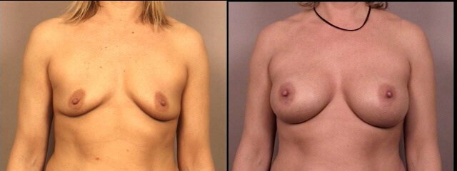 Breast Augmentation Before