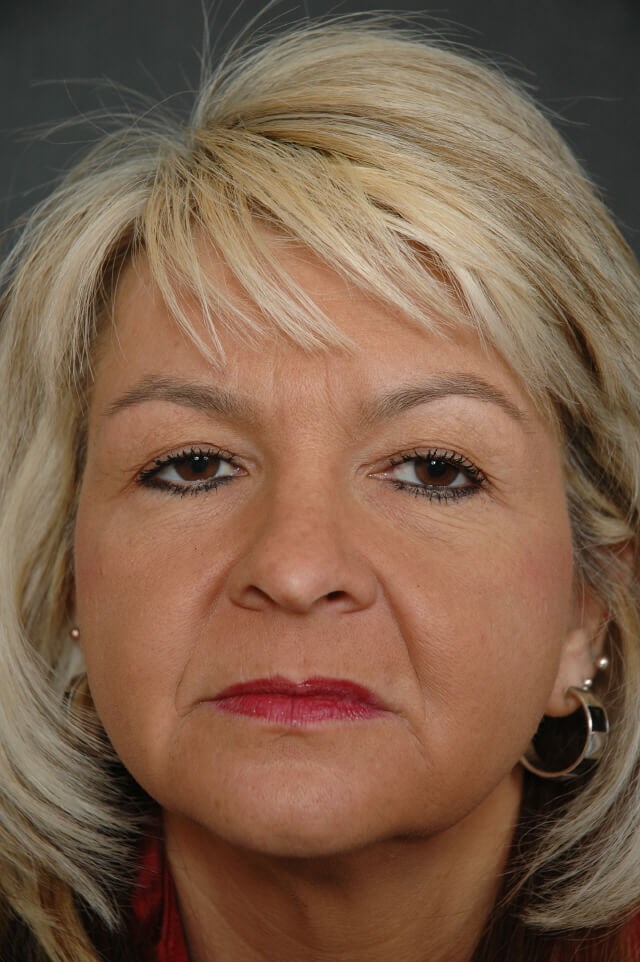 Botox & Filler Before