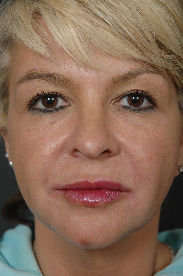 Botox & Filler After
