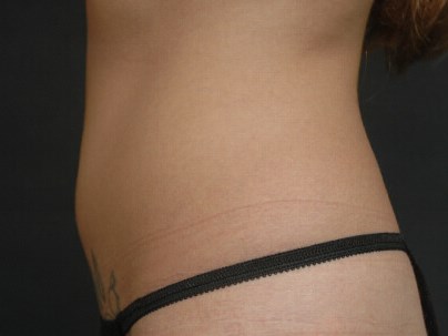 Coolsculpting Before