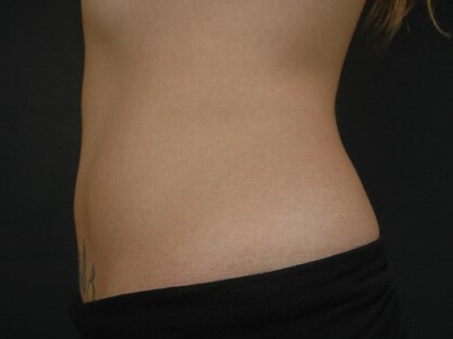 Coolsculpting After