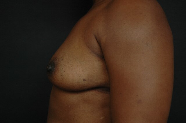 Breast Augmentation Before