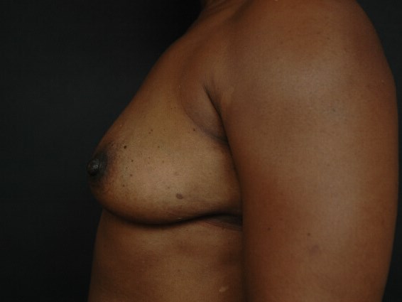 Breast Augmentation Before