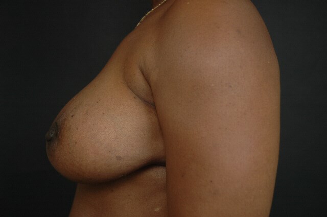 Breast Augmentation After