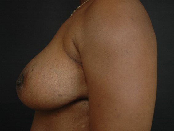 Breast Augmentation After