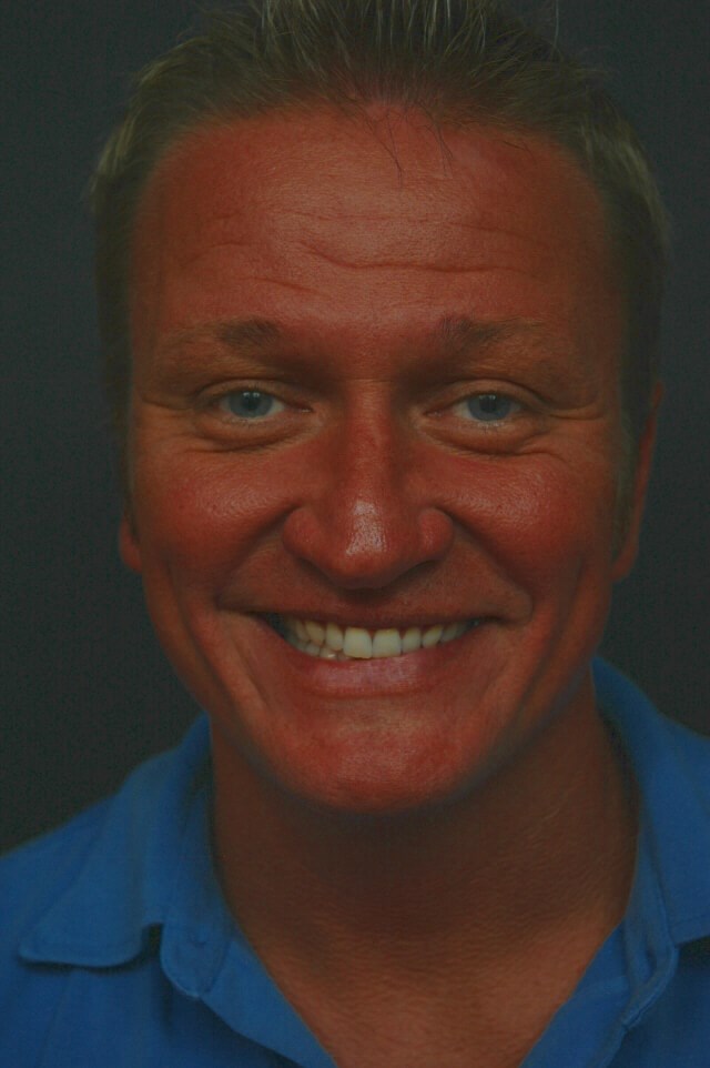 Botox Before