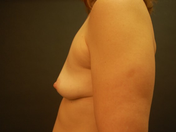 Breast Augmentation Before