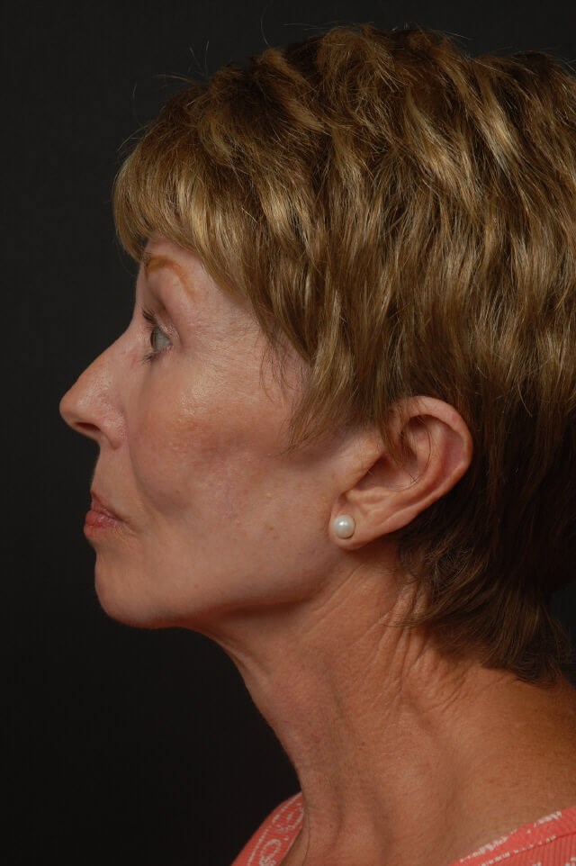 Face lift After