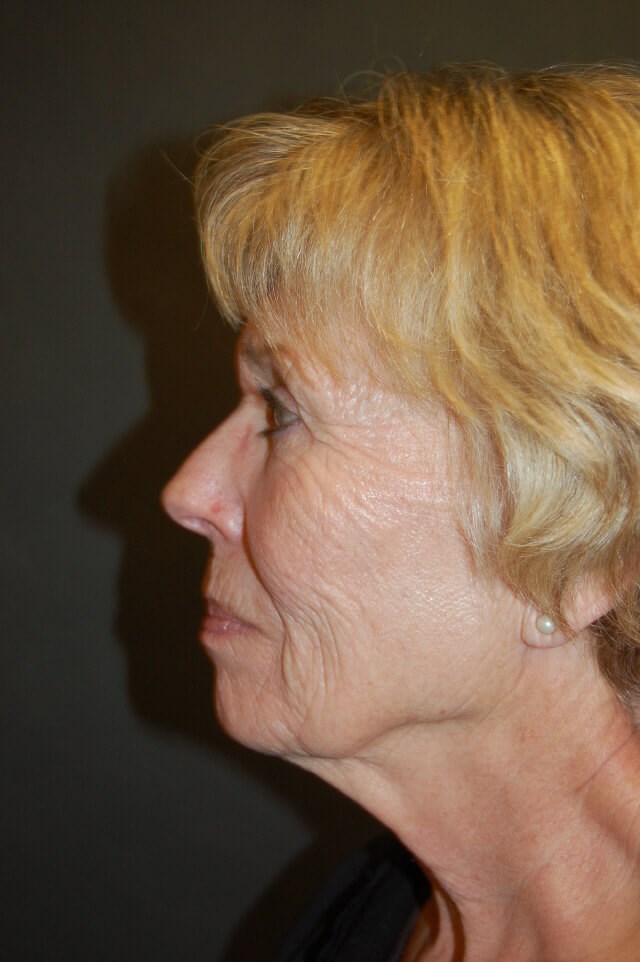 Face lift Before