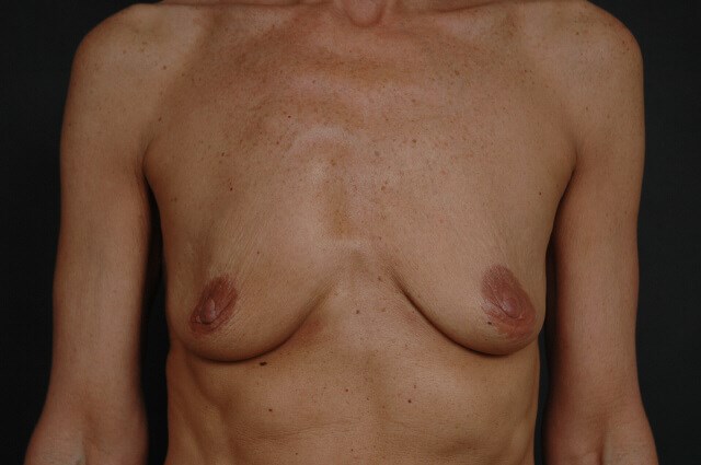 Breast Augmentation Before