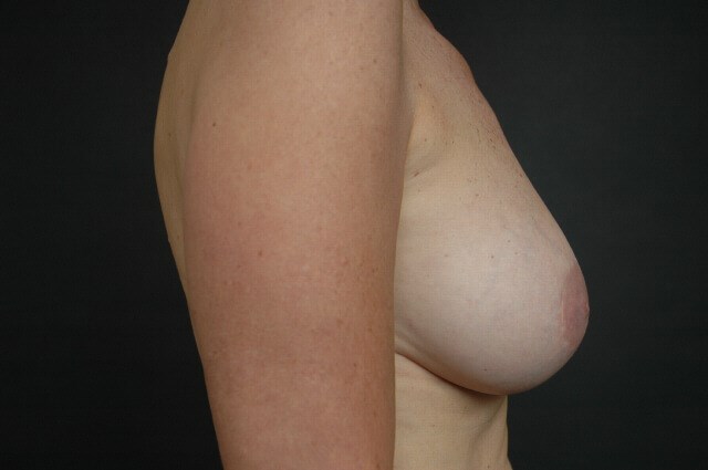 Breast Augmentation After