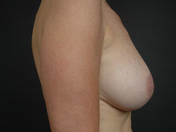 Breast Augmentation After