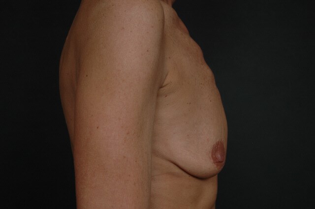 Breast Augmentation Before