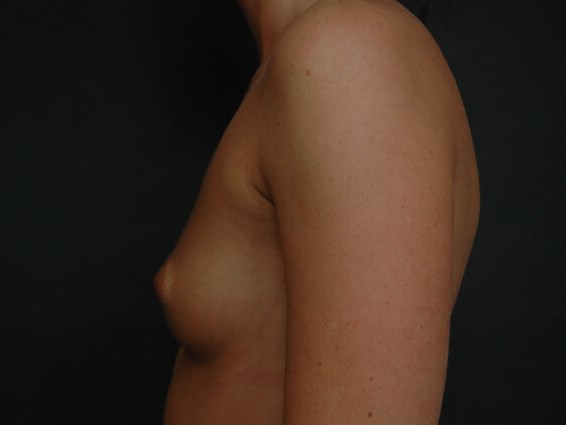 Breast Augmentation Before
