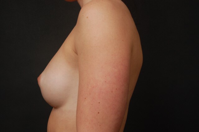 Breast Augmentation After
