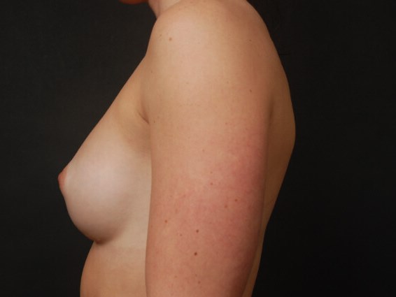 Breast Augmentation After