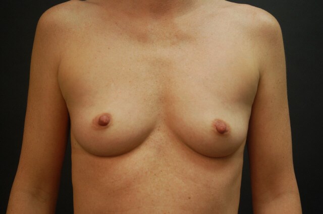 Breast Augmentation Before