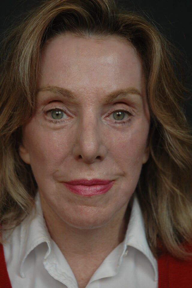 Facelift/laser/eyelid surgery After