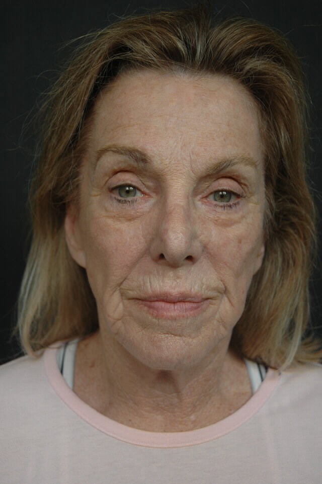 Before Image