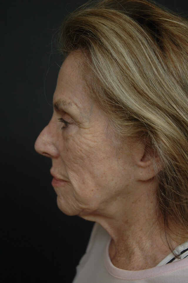 Facelift/laser/eyelid surgery Before