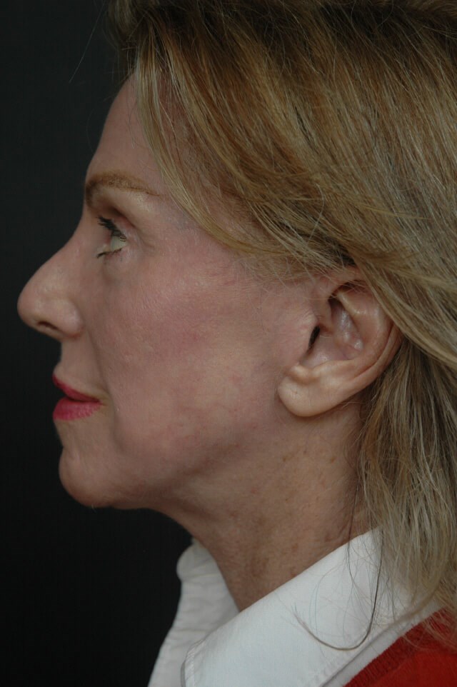 Facelift/laser/eyelid surgery After
