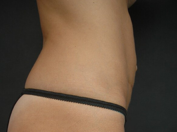 Liposuction - Abdomen After