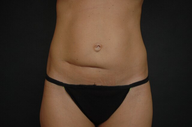 Liposuction - Abdomen Before