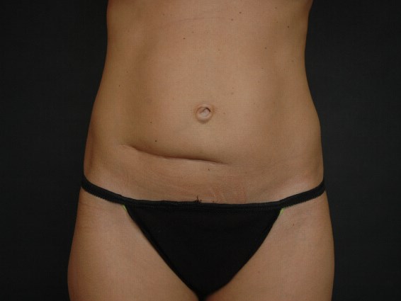 Liposuction - Abdomen Before