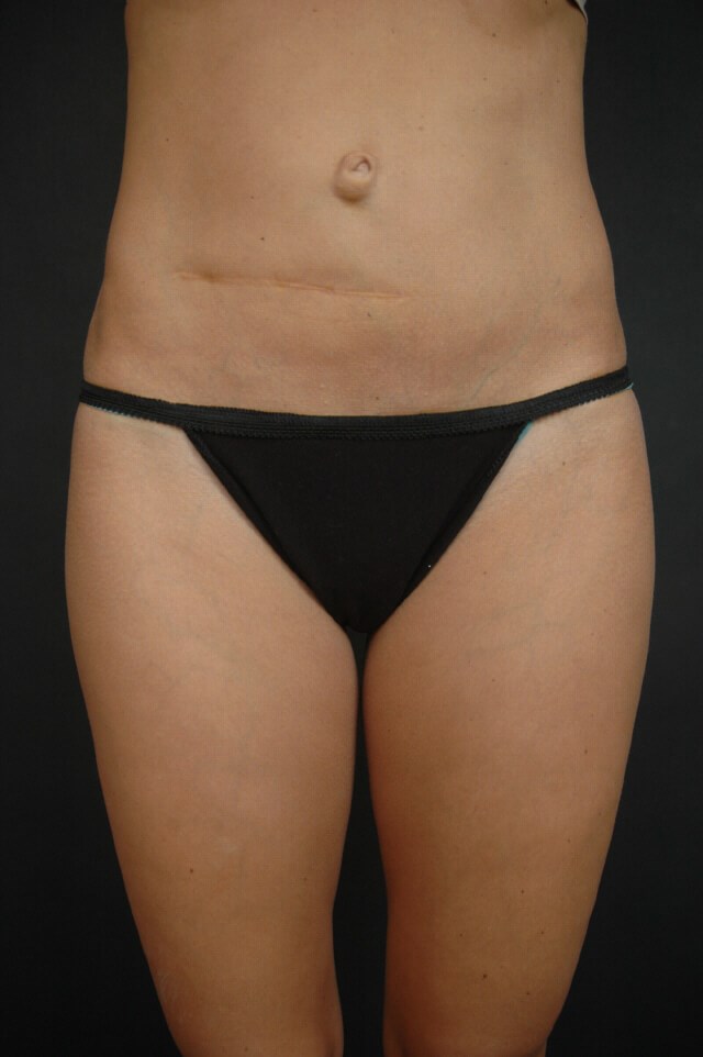 Liposuction - Abdomen After