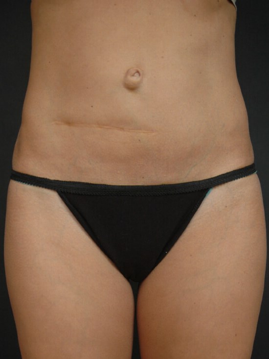 Liposuction - Abdomen After