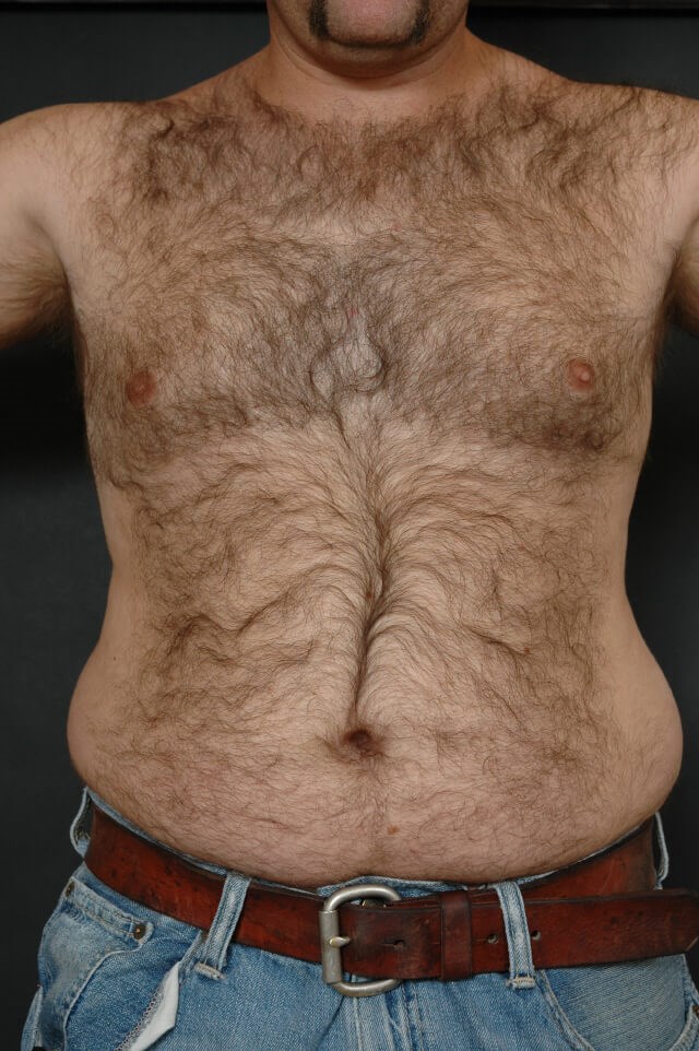 Liposuction - abs/love handles Before
